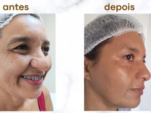 Resultado de tratamento facial — antes e depois