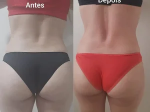 Resultado de drenagem e acompanhamento pós-operatório — antes e depois